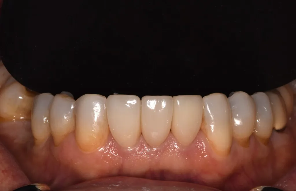 After Porcelain Veneers treatment by Dr Genetti, case 2