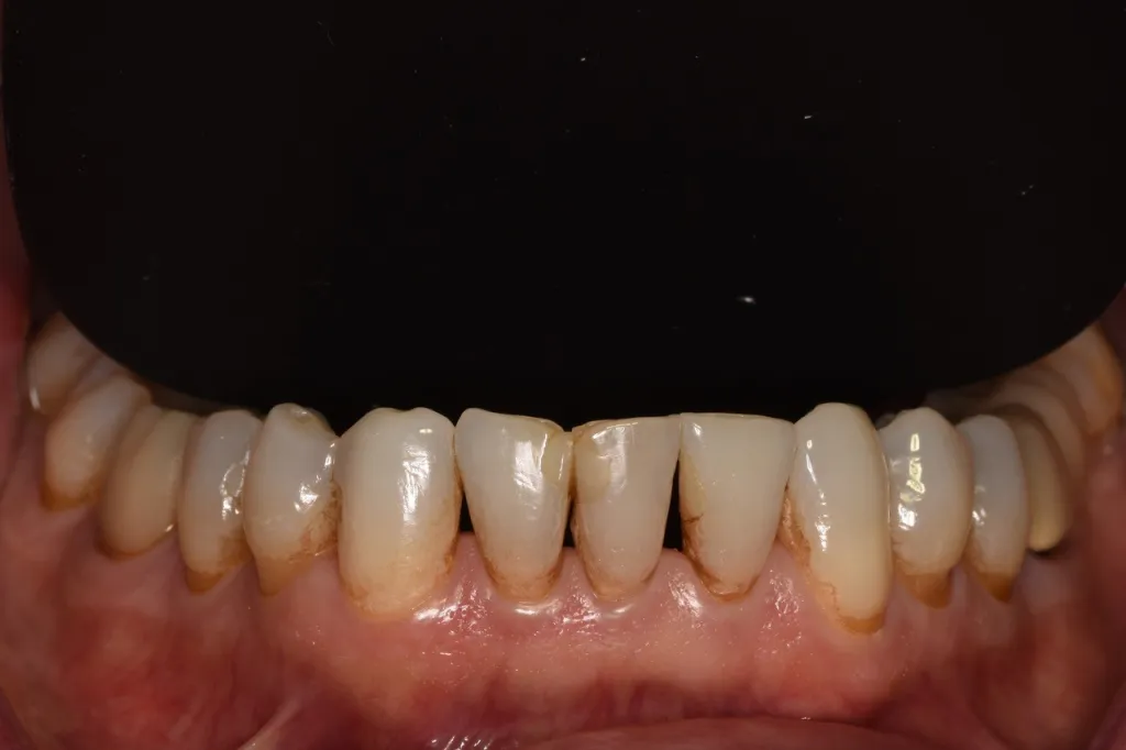 Before Porcelain Veneers treatment by Dr Genetti, case 2