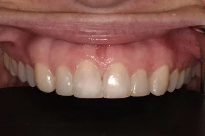 After dental Bonding 