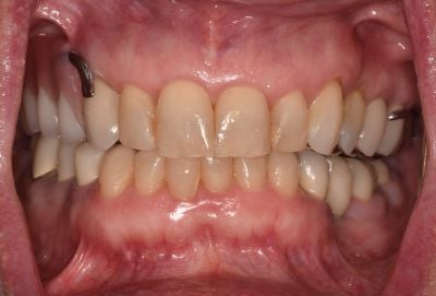 Image of teeth After dentures