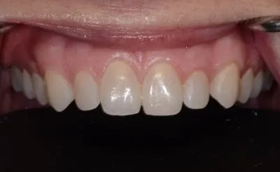 Before dental bonding 