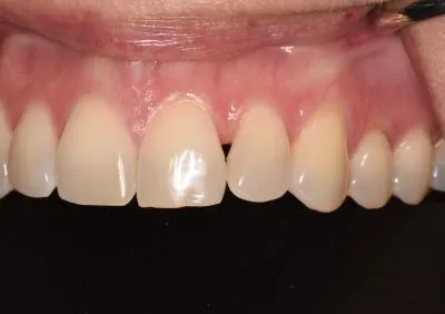 Before dental bonding