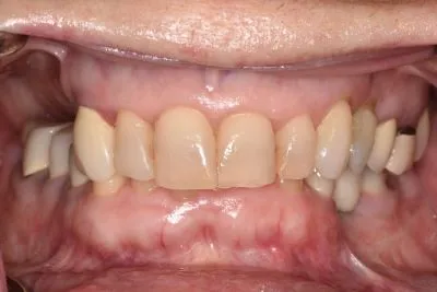 Image of teeth before dentures