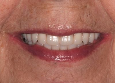 Image of teeth After dentures