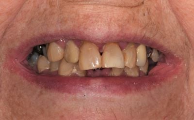 Image of teeth before dentures