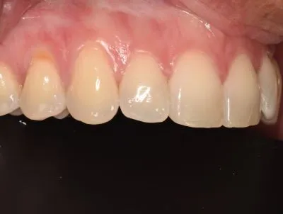 After dental Bonding 