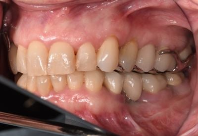 Image of teeth After dentures