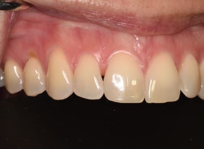 Before dental bonding