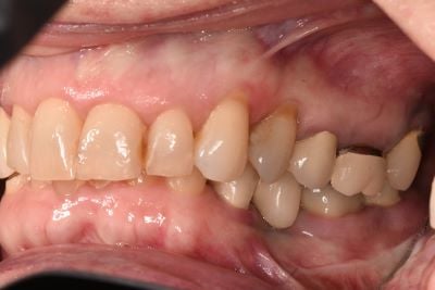 Image of teeth before dentures