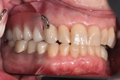 Image of teeth After dentures