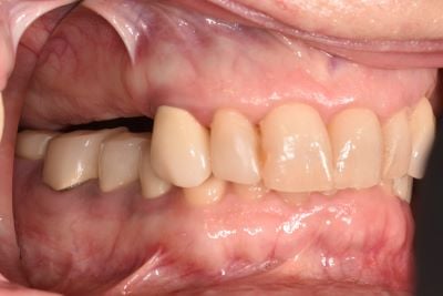 Image of teeth before dentures