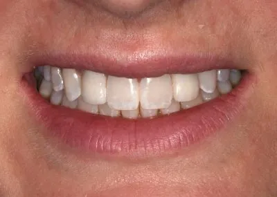 restored with implants and implant crowns