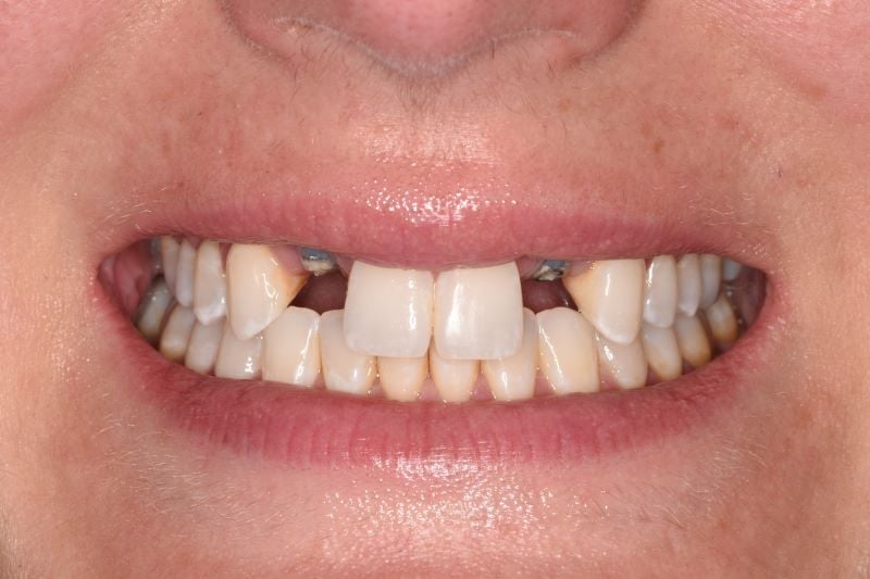 Congenitally missing lateral incisors
