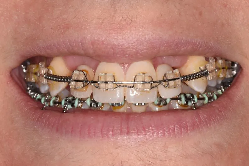 orthodontic movement of teeth for proper spacing and bite