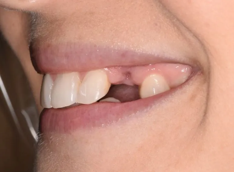 Single missing upper canine