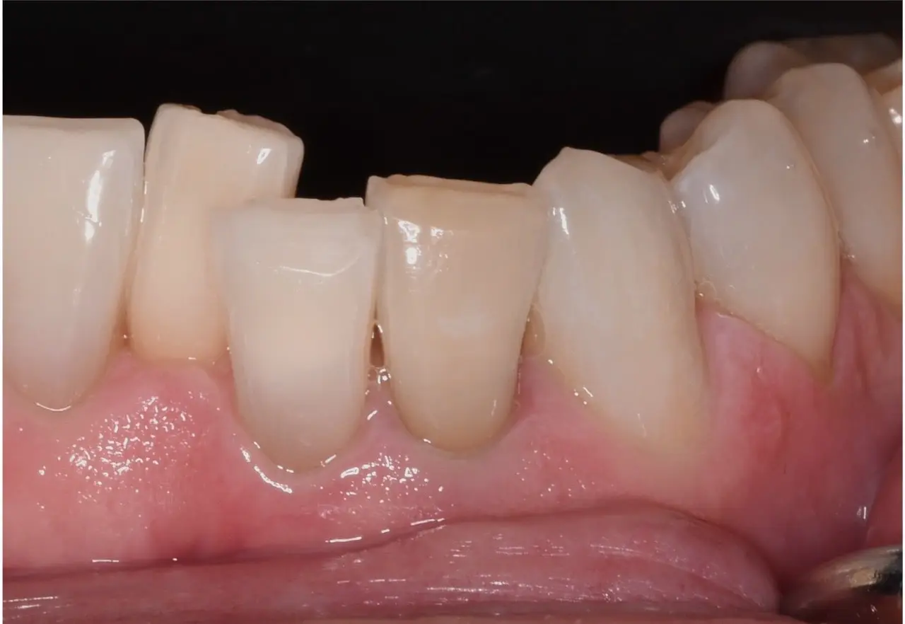 After Teeth Whitening