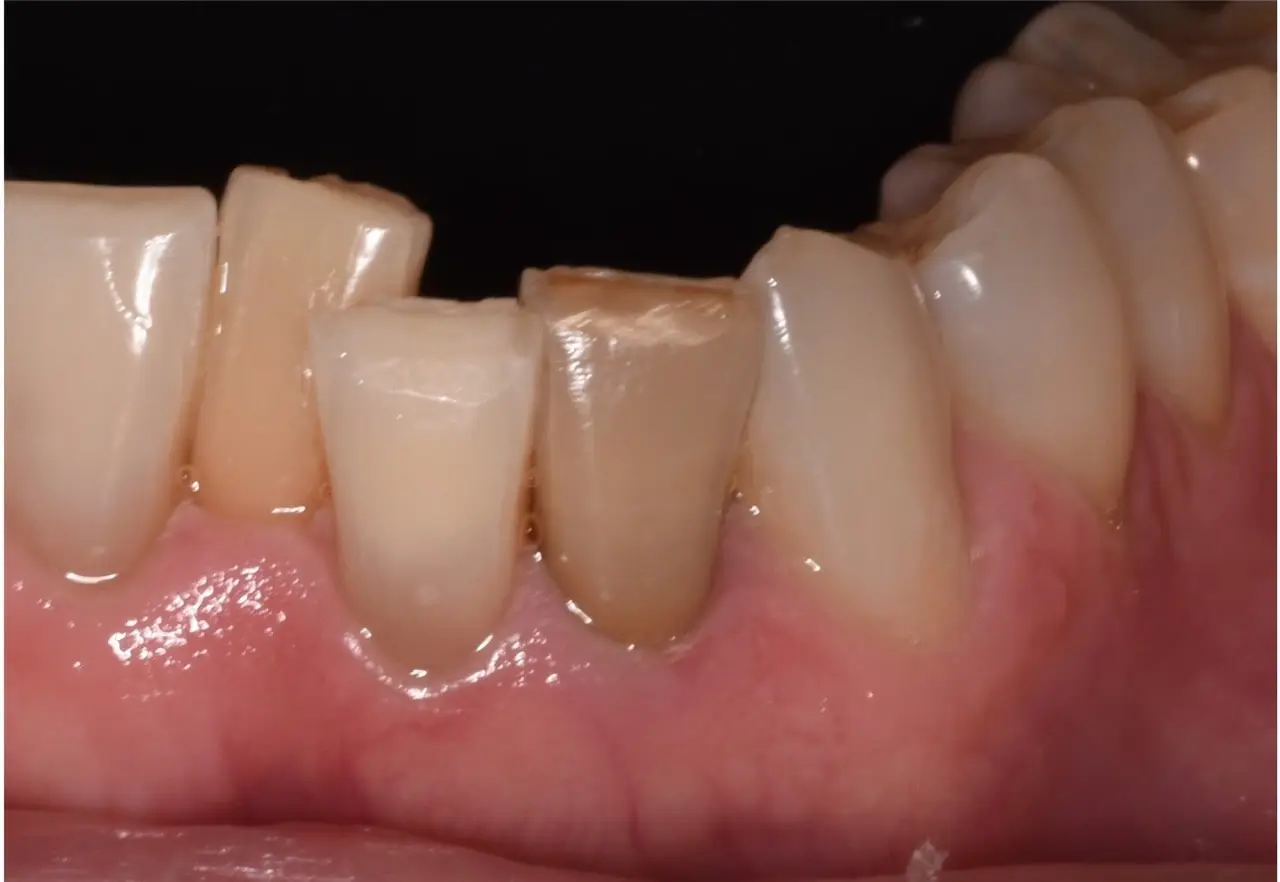 Before Teeth Whitening